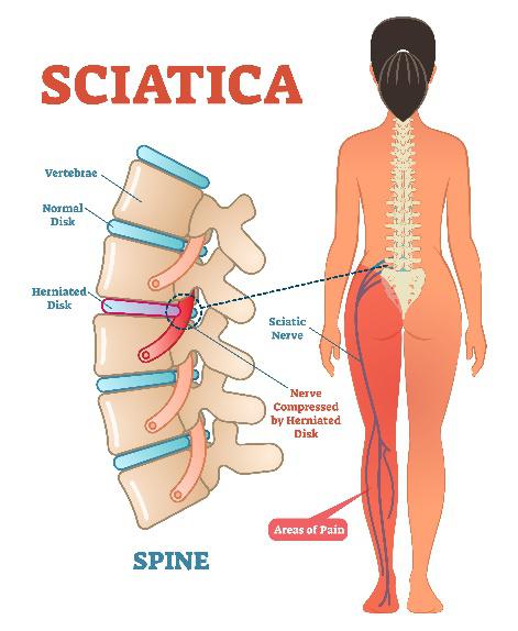 Sciatica and How to Treat it