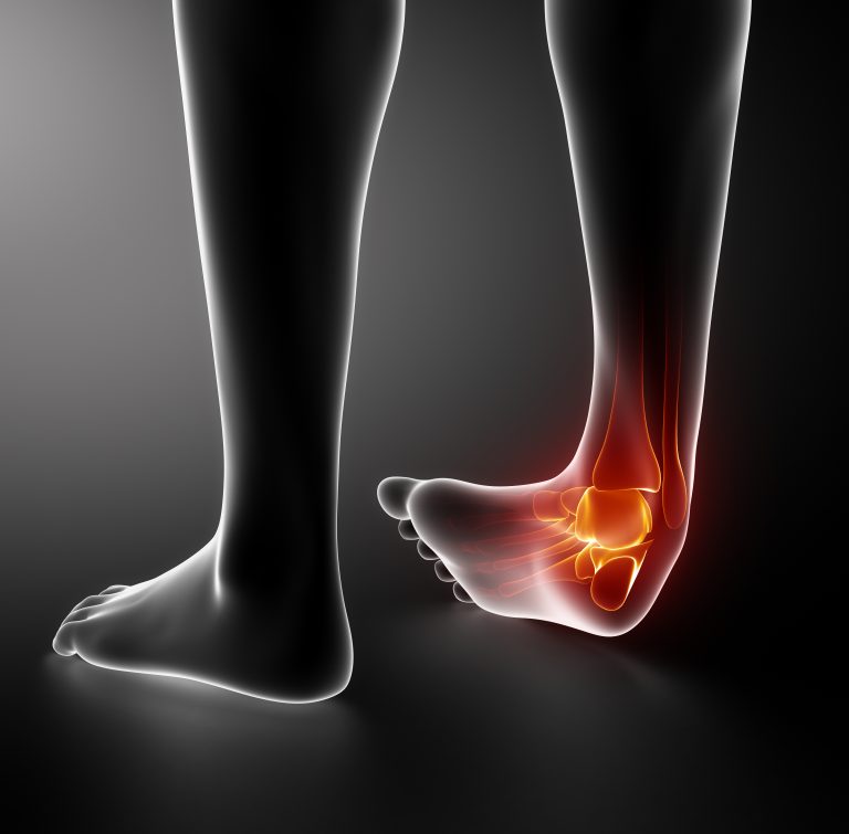 Ankle Sprains and Instability – Movement and Wellbeing Clinic