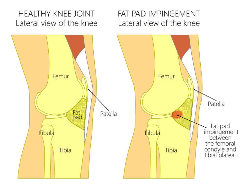 How Is Fat Pad Atrophy Is Connected To Plantar Fasciitis – The Healing Sole